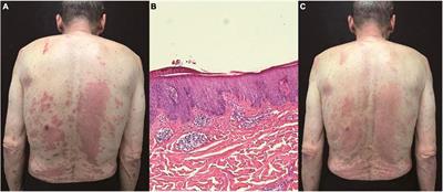 Case report: Treatment of psoriasiform dermatitis in patients with malignancy